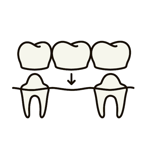 dental bridges